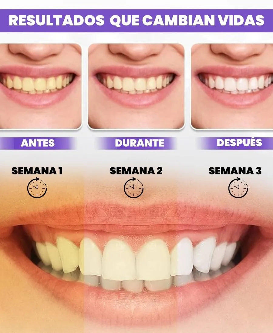 SMILEKIT | Blanquedor dental | Tratamiento efectivo contra las manchas amarilllas de los dientes sin causar sensibilidad